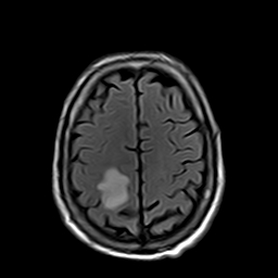 File:Brain abscess complicated by intraventricular rupture and ventriculitis (Radiopaedia 82434-96571 Axial FLAIR 19).jpg