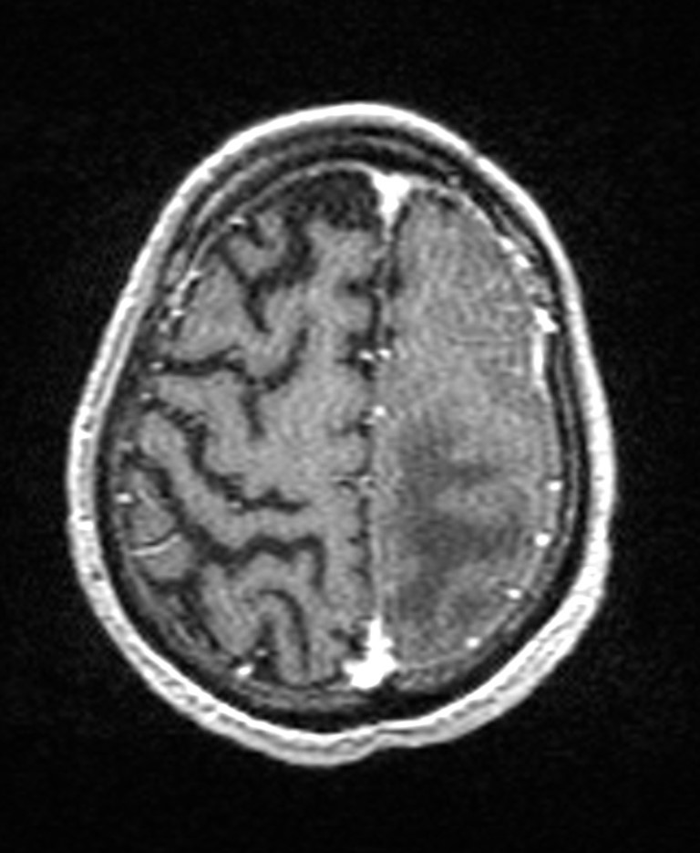 Brain abscess with dual rim sign (Radiopaedia 87566-103938 Axial T1 C+ 132).jpg