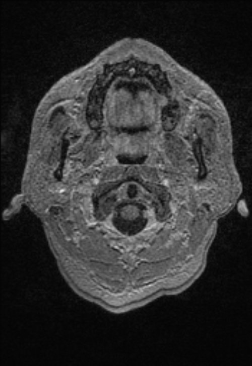 Brain abscess with ventriculitis (Radiopaedia 85703-101495 Axial T1 C+ 10).jpg