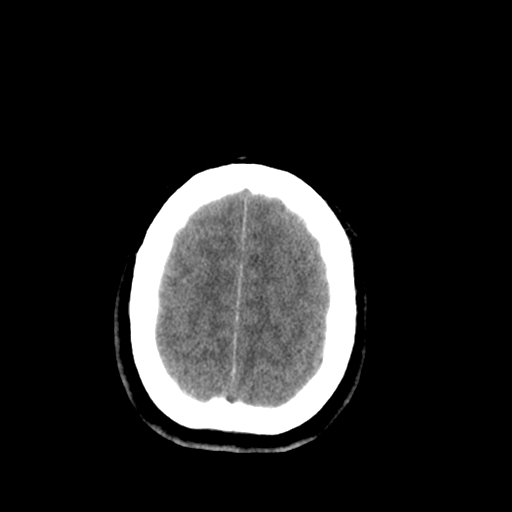 File:Brain contusions, internal carotid artery dissection and base of skull fracture (Radiopaedia 34089-35339 Axial non-contrast 40).png