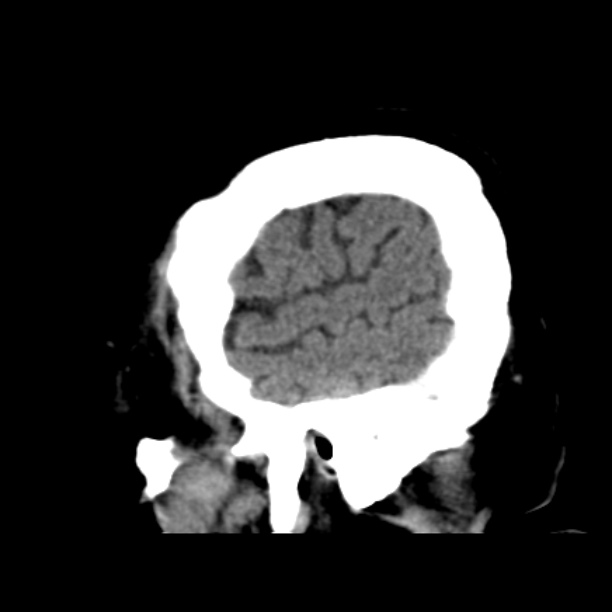 Brain cortical laminar necrosis (Radiopaedia 25822-25971 non-contrast 8).jpg