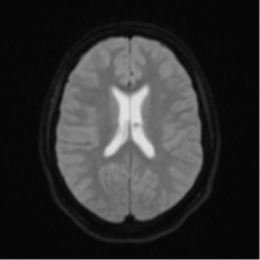 Brain death (Radiopaedia 43754-47237 Axial DWI 17).png