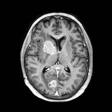 File:Brain metastases from lung cancer (Radiopaedia 83839-99028 Axial T1 C+ 34).jpg