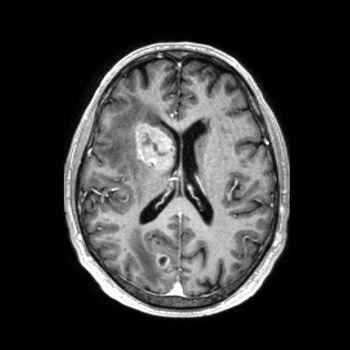 Brain metastases from lung cancer (Radiopaedia 83839-99028 Axial T1 C+ 38).jpg