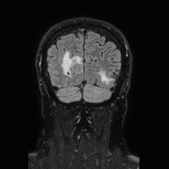 Brain metastases from lung cancer (Radiopaedia 83839-99028 Coronal FLAIR 70).jpg