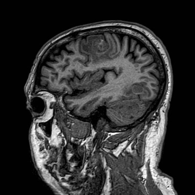 Brain metastases from lung cancer (Radiopaedia 83839-99028 Sagittal T1 99).jpg