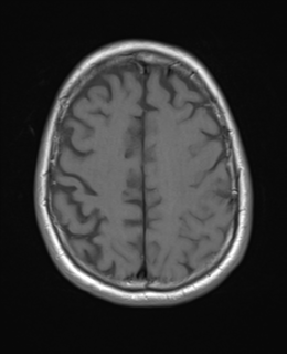 File:Brain metastasis (large cystic mass) (Radiopaedia 47497-52107 Axial T1 21).png