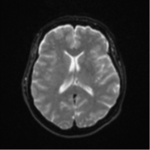 Brain metastasis (sarcoma) (Radiopaedia 47576-52209 Axial DWI 15).png