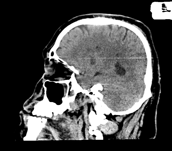 Brainstem hemorrhage (Radiopaedia 81294-94976 C 19).jpg