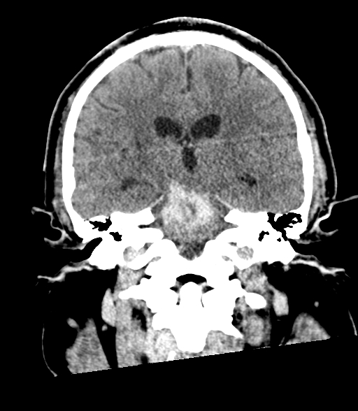 Brainstem hemorrhage (Radiopaedia 81294-94976 Coronal non-contrast 39).jpg