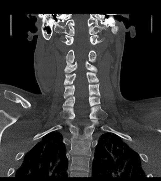 Branchial cleft cyst (Radiopaedia 31167-31875 Coronal bone window 43).jpg