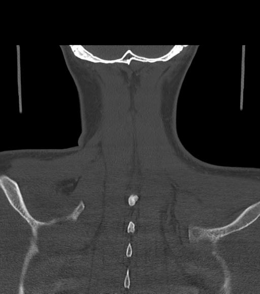 Branchial cleft cyst (Radiopaedia 31167-31875 Coronal bone window 57).jpg