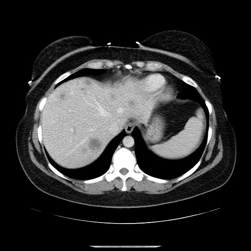 File:Breast cancer pseudocirrhosis after chemotherapy (Radiopaedia 65407-74456 Axial 29).jpg