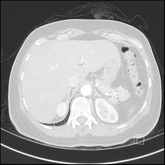 File:Breast metastases from renal cell cancer (Radiopaedia 79220-92225 Axial lung window 81).jpg