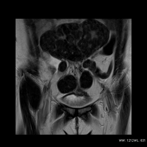 File:Broad ligament fibroid (Radiopaedia 49135-54241 Coronal T2 6).jpg