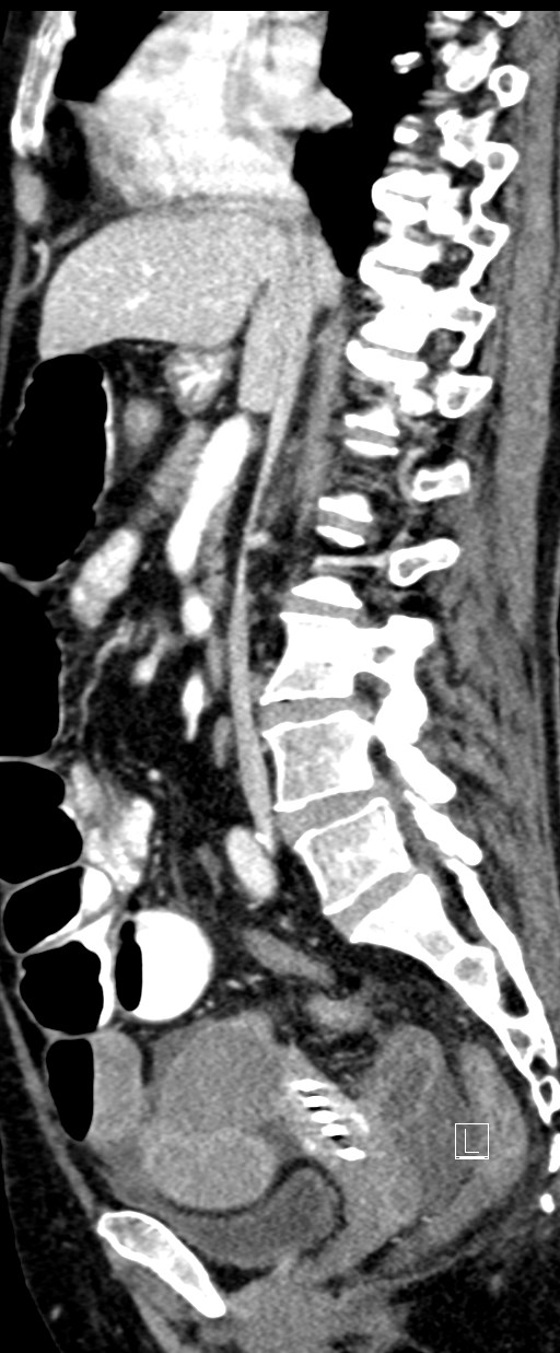 Broad ligament hernia (Radiopaedia 84802-100276 C 43).jpg