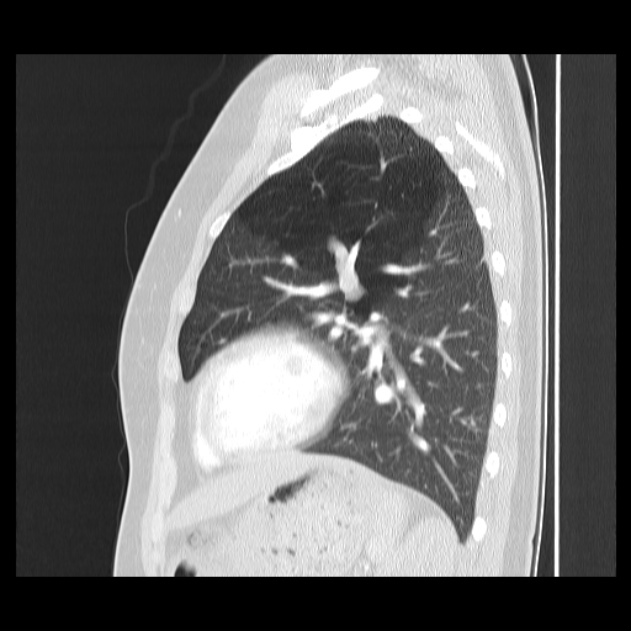 Bronchial atresia (Radiopaedia 22965-22992 Sagittal lung window 18).jpg