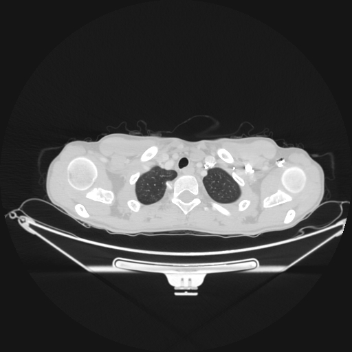 File:Bronchial carcinoid tumor (Radiopaedia 57187-64090 Axial lung window 5).jpg
