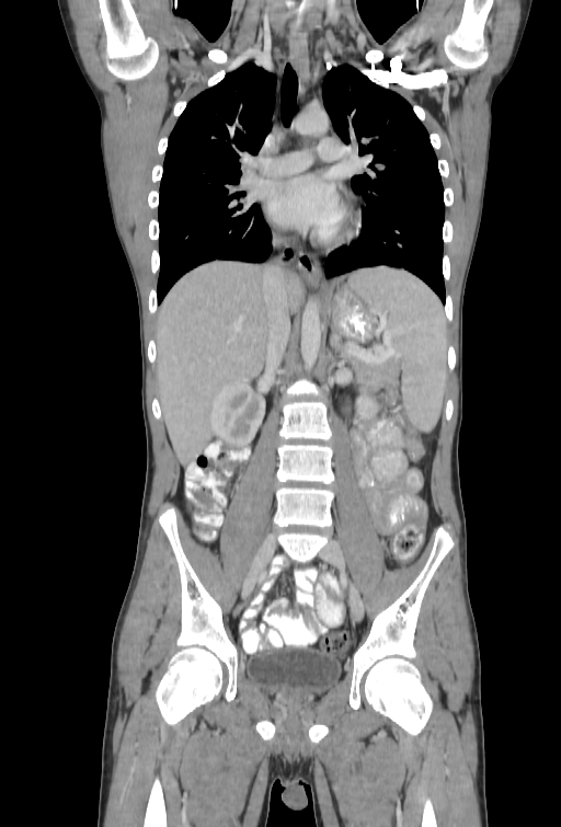 Bronchial carcinoid tumor (Radiopaedia 57187-64090 B 52).jpg
