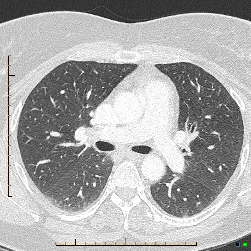 Bronchial diverticula (Radiopaedia 79512-92676 Axial lung window 79).jpg