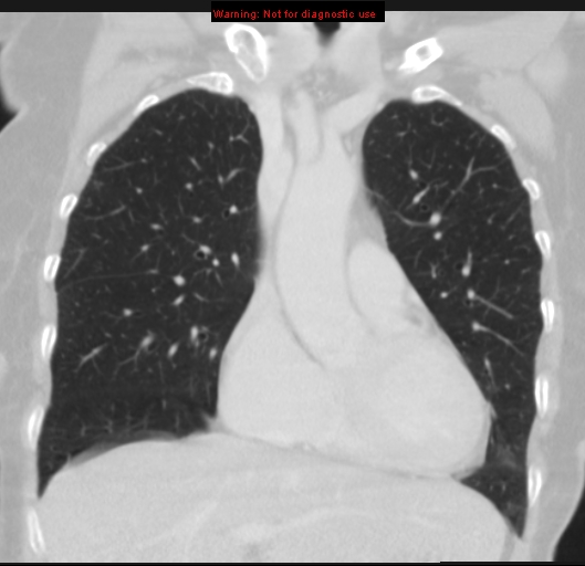 Bronchoalveolar carcinoma (BAC) (Radiopaedia 13436-13392 Coronal lung window 20).jpg