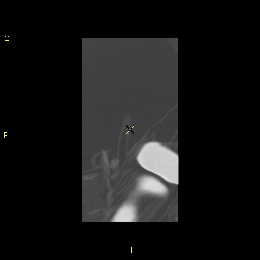 File:Bronchogenic carcinoma as an incidental finding (Radiopaedia 16453-16130 Coronal lung window 4).jpg