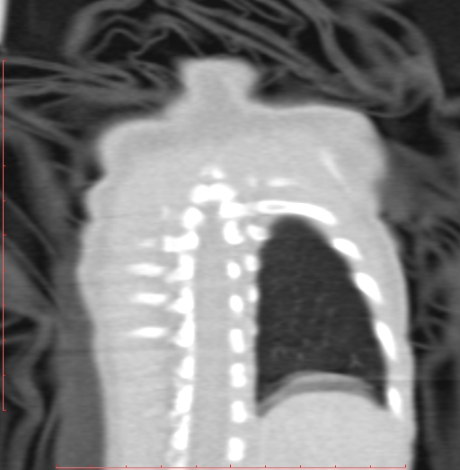 Bronchogenic cyst (Radiopaedia 78599-91409 Coronal lung window 198).jpg