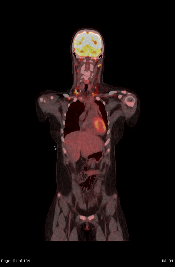 Brown fat uptake (FDG PET-CT) (Radiopaedia 77392-89513 Fused coronal 42).jpg