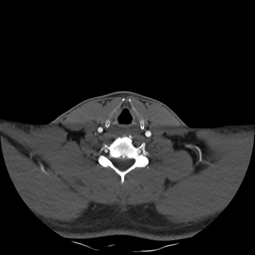 Buccal fat pad arteriovenous malformation (Radiopaedia 70936-81144 A 81).jpg
