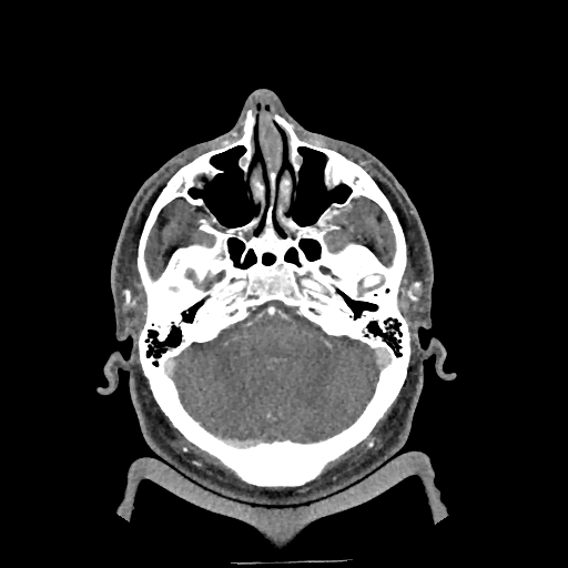 Buccal fat pad arteriovenous malformation (Radiopaedia 70936-81144 D 255).jpg