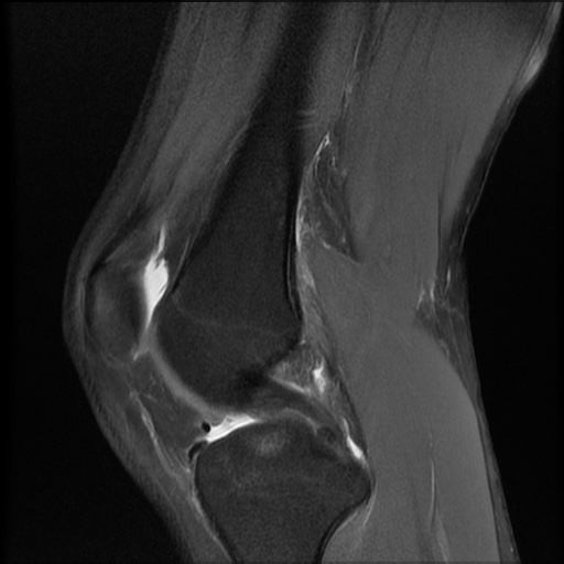 File:Bucket-handle meniscus tear (Radiopaedia 65700-74809 Sagittal PD fat sat 10).jpg