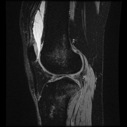 Bucket handle meniscus tear (Radiopaedia 56916-63751 H 28).jpg