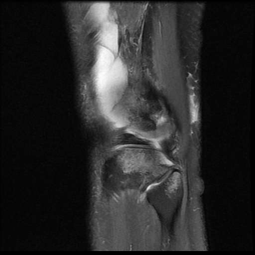 File:Bucket handle meniscus tear (Radiopaedia 56916-63751 Sagittal PD fat sat 3).jpg