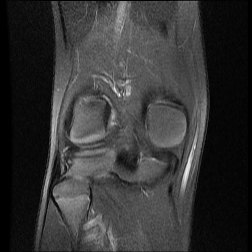 File:Bucket handle tear - lateral meniscus (Radiopaedia 72124-82634 Coronal PD fat sat 13).jpg