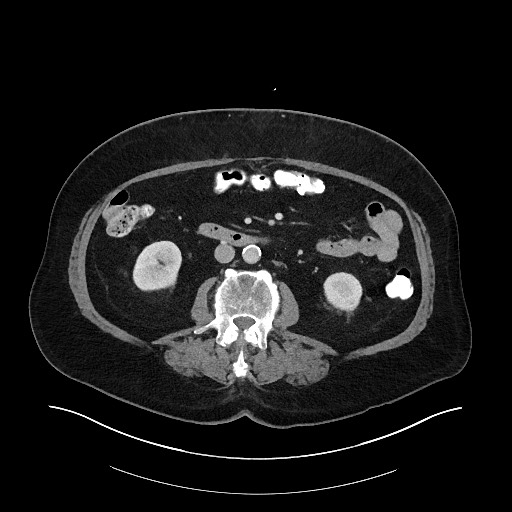 Buried bumper syndrome - gastrostomy tube (Radiopaedia 63843-72575 A 42).jpg