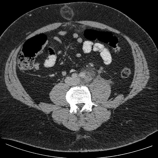 Burned-out testicular seminoma - retroperitoneal nodal metastases (Radiopaedia 62872-71245 A 45).jpg