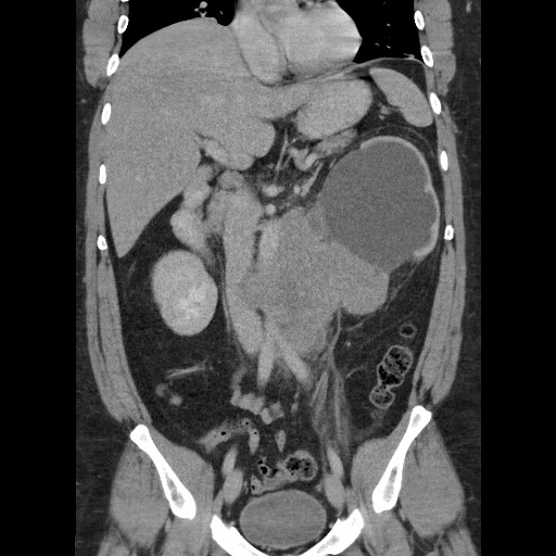 Burned-out testicular seminoma - retroperitoneal nodal metastases (Radiopaedia 62872-71245 B 34).jpg