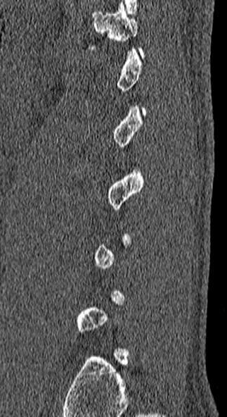 File:Burst fracture (Radiopaedia 53373-59357 Sagittal bone window 10).jpg