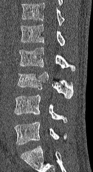 Burst fracture (Radiopaedia 53373-59357 Sagittal bone window 32).jpg