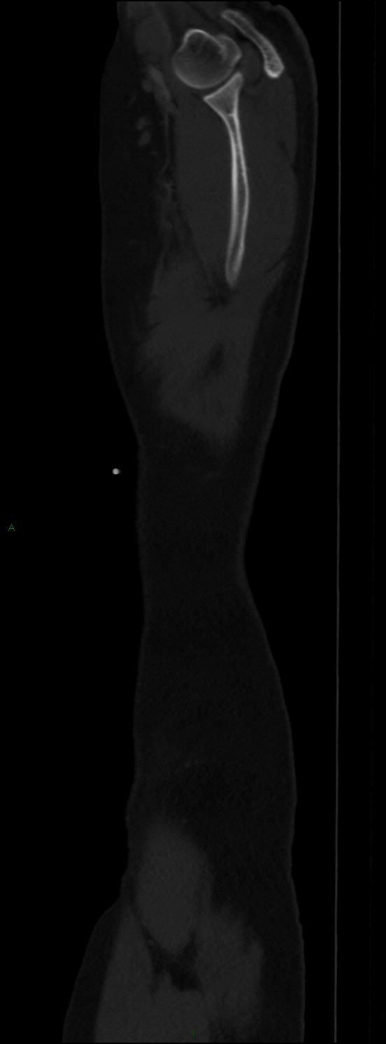 Burst fracture (Radiopaedia 83168-97542 Sagittal bone window 116).jpg
