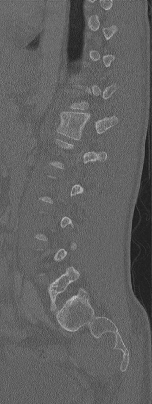 Burst fracture - T12 with conus compression (Radiopaedia 56825-63647 Sagittal bone window 27).png