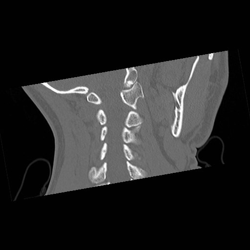 File:C1-C2 "subluxation" - normal cervical anatomy at maximum head rotation (Radiopaedia 42483-45607 Coronal non-contrast 38).jpg
