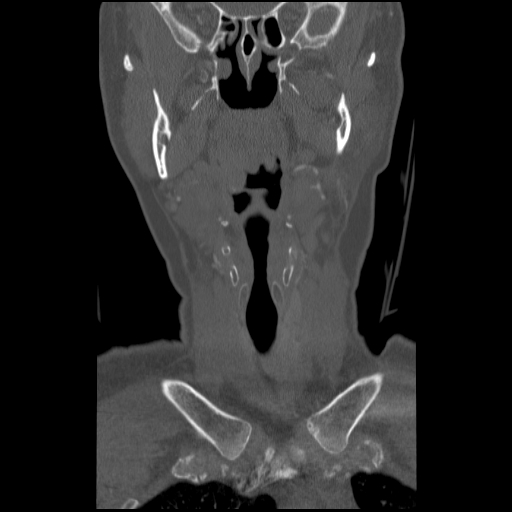 C1 anterior arch (plough) fracture - type 1 (Radiopaedia 76181-87720 Coronal bone window 79).jpg