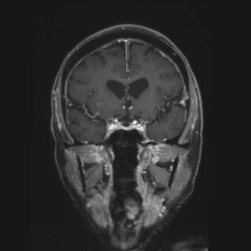 CNS lymphoma with steroid response (Radiopaedia 37980-39921 Coronal T1 C+ 15).png