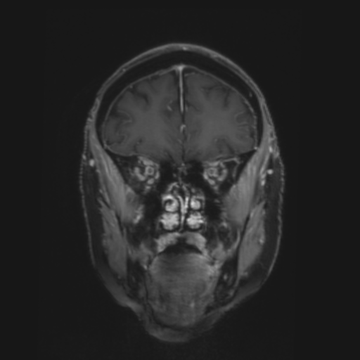 File:CNS lymphoma with steroid response (Radiopaedia 37980-39921 Coronal T1 C+ 8).png