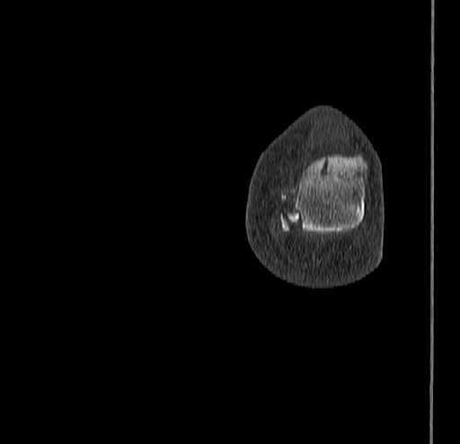 Calcaneal fracture - Sanders type 4 (Radiopaedia 90179-107370 Coronal bone window 89).jpg