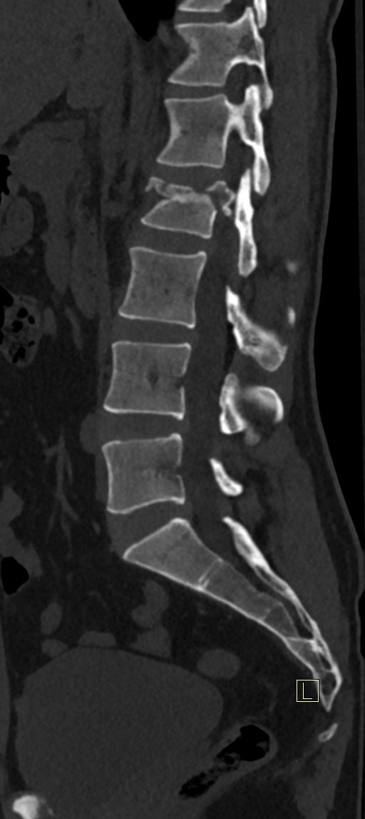Calcaneal fractures with associated L2 burst fracture (Radiopaedia 71671-82493 Sagittal bone window 41).jpg