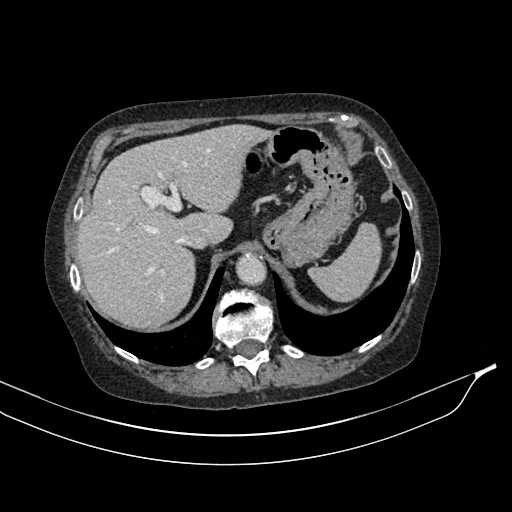 Calcified adrenal glands and Spigelian hernia (Radiopaedia 49741-54988 A 43).jpg