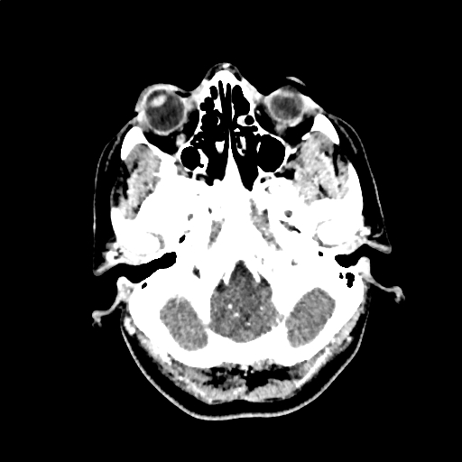 File:Calcified cerebral hydatid cyst (Radiopaedia 65603-74717 Axial with contrast 5).jpg