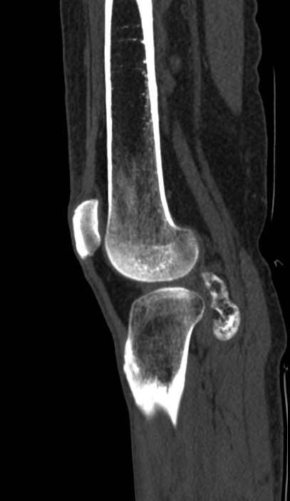 Calcified hematoma - popliteal fossa (Radiopaedia 63938-72763 Sagittal bone window 85).jpg